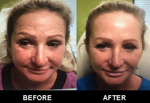 Botox result at Zinnia Aesthetics and Anti-Aging Clinic in Fairfax, VA