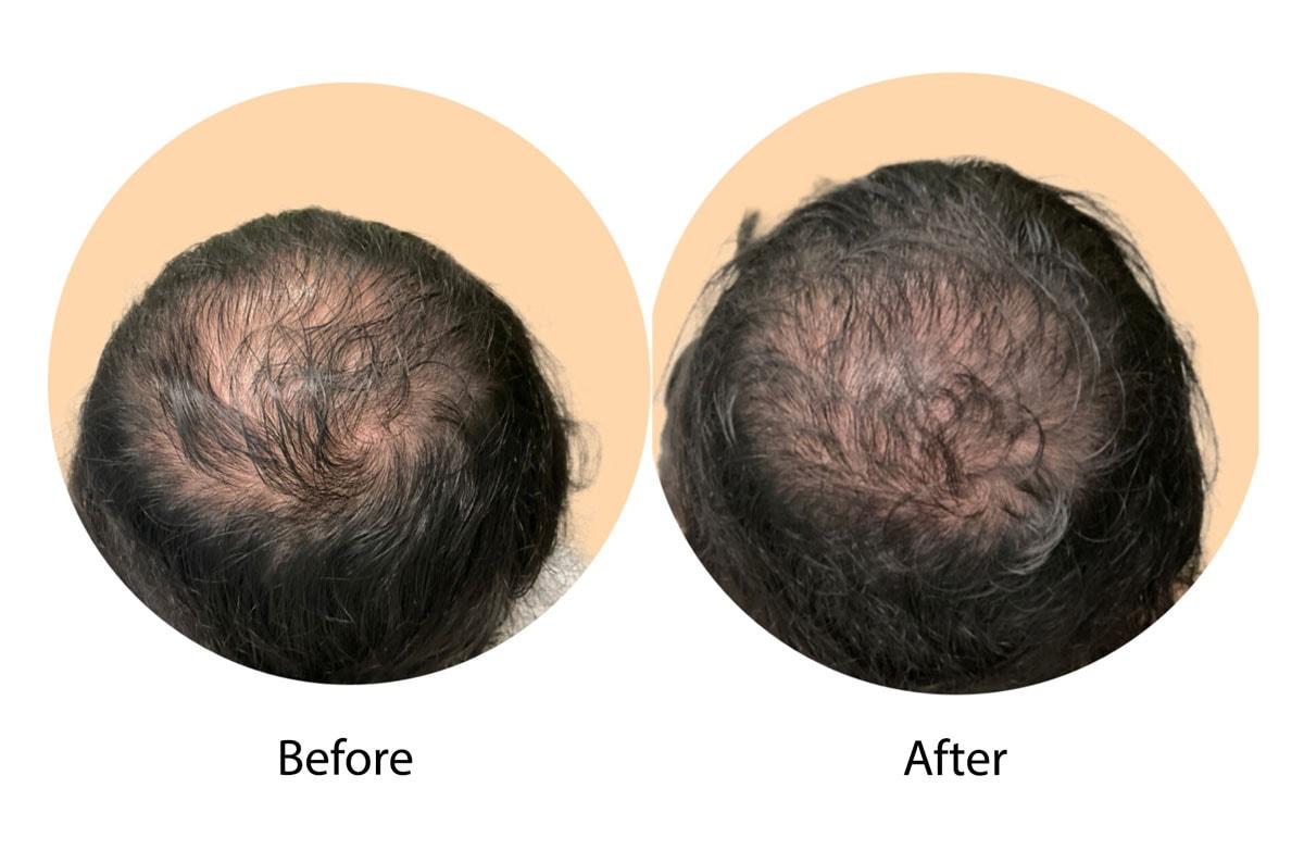 Zinnia Aesthetics and Anti-Aging Clinic prp for hair result — Fairfax, VA