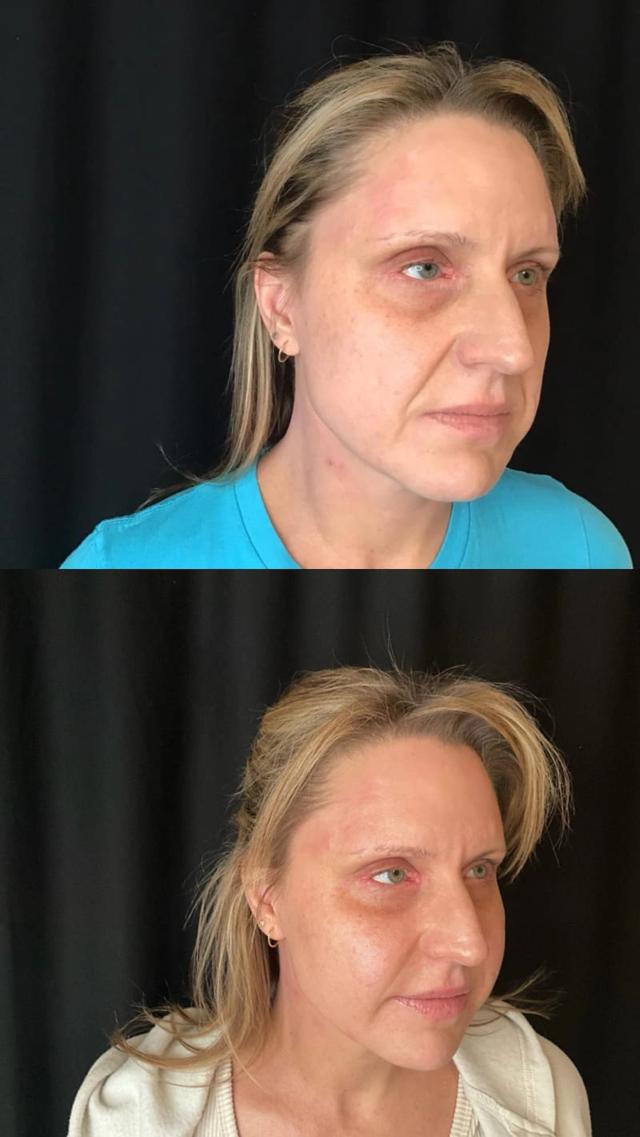 Fat Transfer result at Zinnia Aesthetics and Anti-Aging Clinic in Fairfax, VA