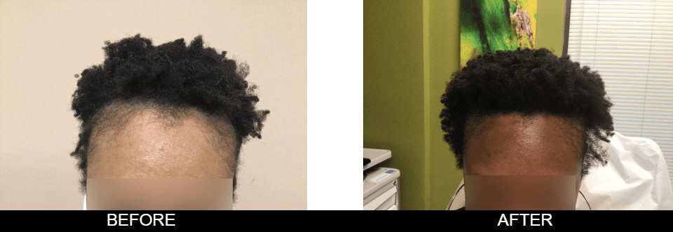 Zinnia Aesthetics and Anti-Aging Clinic result — Fairfax, VA