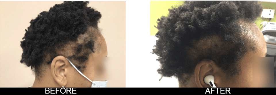 Zinnia Aesthetics and Anti-Aging Clinic result — Fairfax, VA