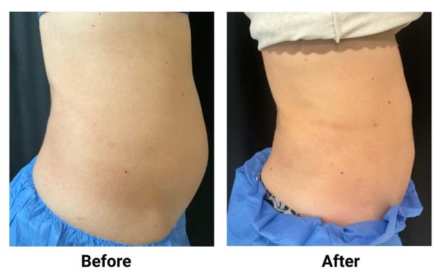 Liposuction result at Zinnia Aesthetics and Anti-Aging Clinic in Fairfax, VA