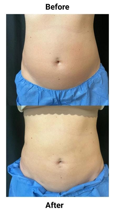 Liposuction result at Zinnia Aesthetics and Anti-Aging Clinic in Fairfax, VA