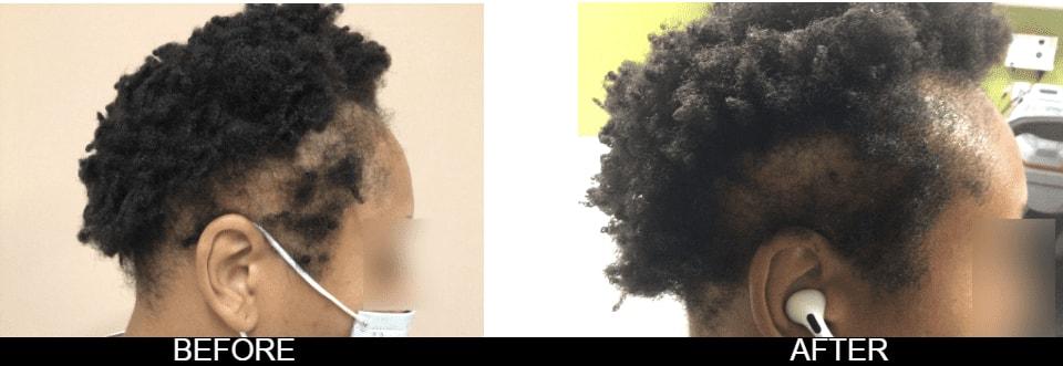 Zinnia Aesthetics and Anti-Aging Clinic prp for hair result — Fairfax, VA