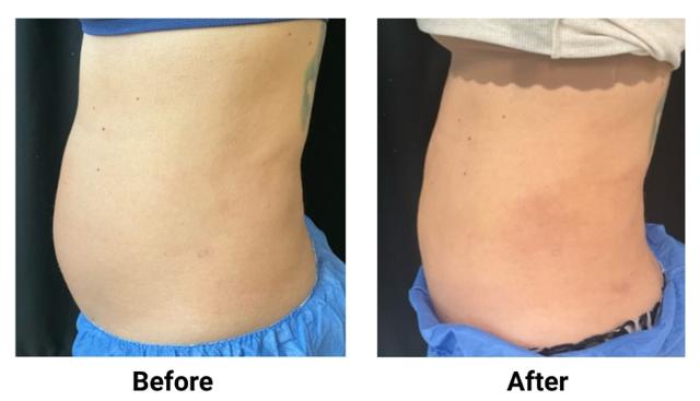 Liposuction result at Zinnia Aesthetics and Anti-Aging Clinic in Fairfax, VA