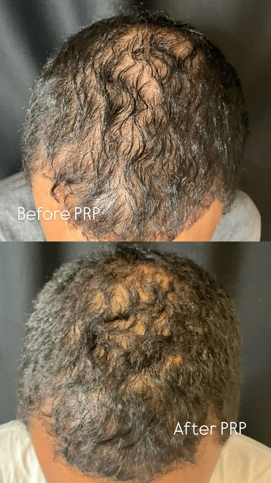 Zinnia Aesthetics and Anti-Aging Clinic prp for hair result — Fairfax, VA