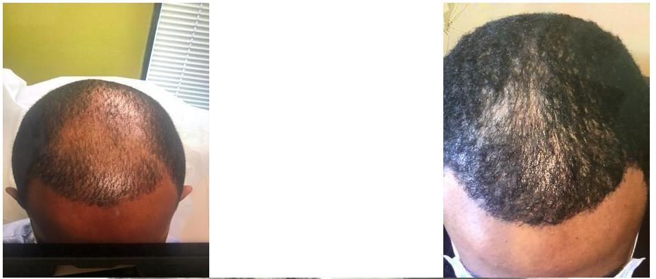 Zinnia Aesthetics and Anti-Aging Clinic result — Fairfax, VA