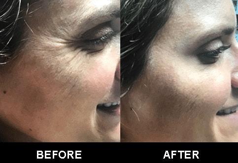 Botox result at Zinnia Aesthetics and Anti-Aging Clinic in Fairfax, VA