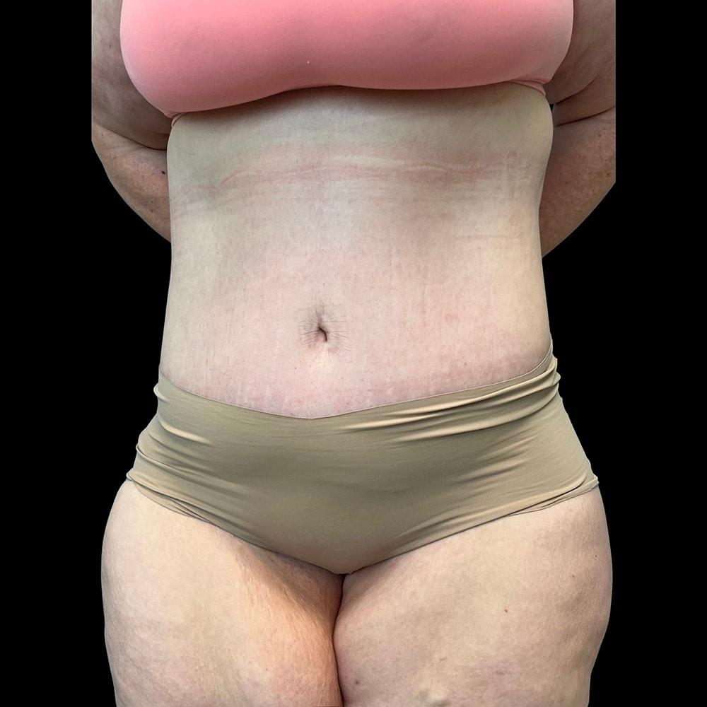 Designer Plastic Surgery tummy tuck after — Richmond, TX