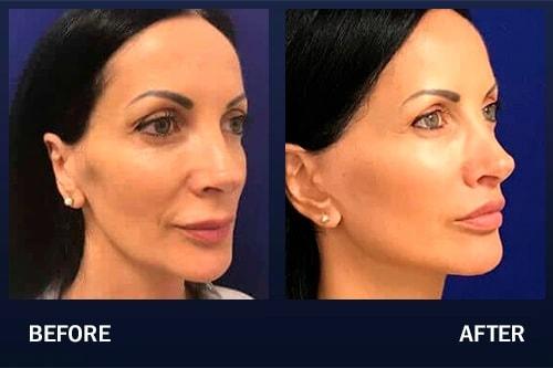 Madnani Facial Plastics jawline filler result — Woodbury, NY