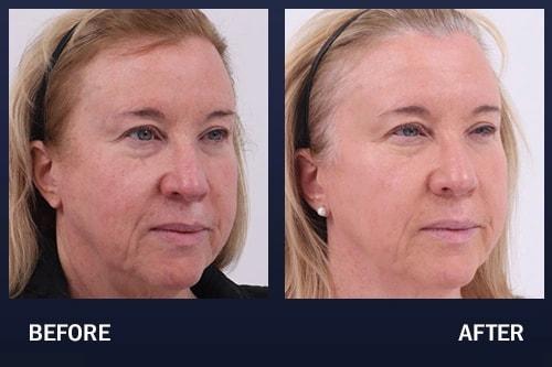 Madnani Facial Plastics photofacial result — Woodbury, NY