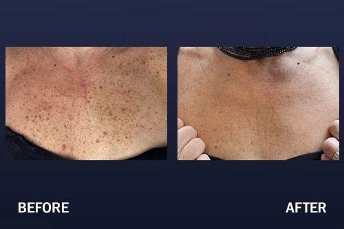 Madnani Facial Plastics photofacial result — Woodbury, NY