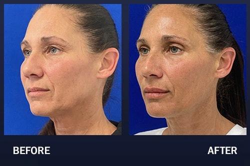 Madnani Facial Plastics cheek filler result — Woodbury, NY