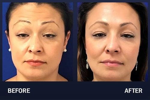 Madnani Facial Plastics cheek filler result — Woodbury, NY