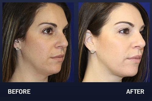 Madnani Facial Plastics cheek filler result — Woodbury, NY