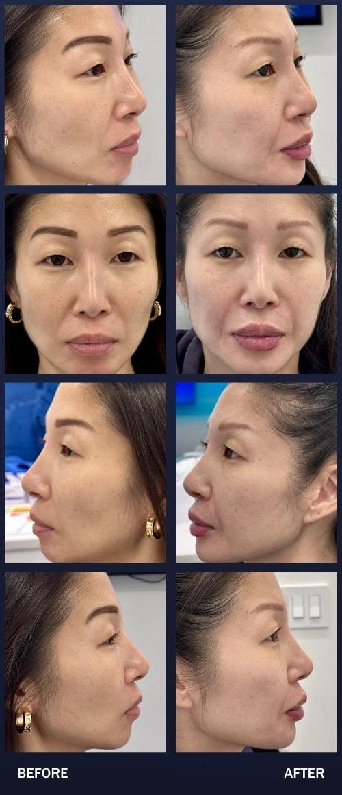 Madnani Facial Plastics cheek filler result — Woodbury, NY
