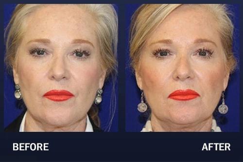 Madnani Facial Plastics cheek filler result — Woodbury, NY