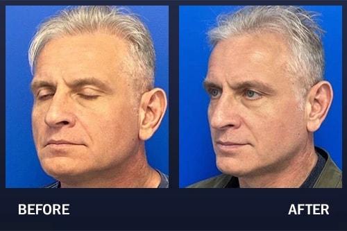 Madnani Facial Plastics jawline filler result — Woodbury, NY