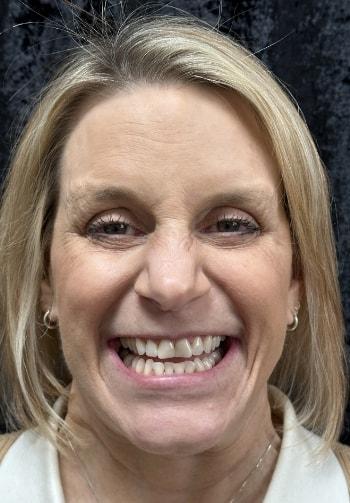 Dental Veneers before at Preston Bend Dental in Plano, TX