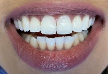 Preston Bend Dental dental bonding after — Plano, TX