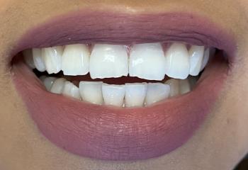 Dental Implants before at Preston Bend Dental in Plano, TX