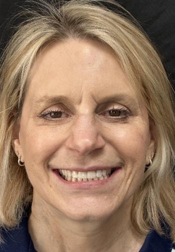 Dental Veneers after at Preston Bend Dental in Plano, TX