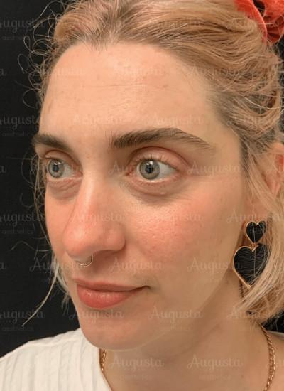Lip Filler before at Augusta Aesthetics in Cincinnati, OH