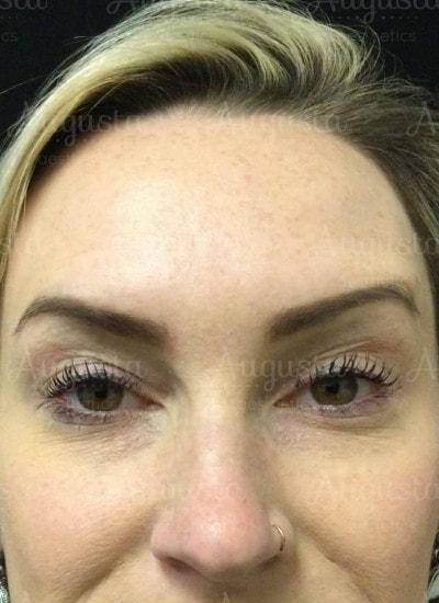 Botox after at Augusta Aesthetics in Cincinnati, OH