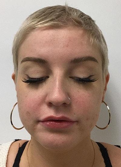 Augusta Aesthetics lip filler after — Cincinnati, OH