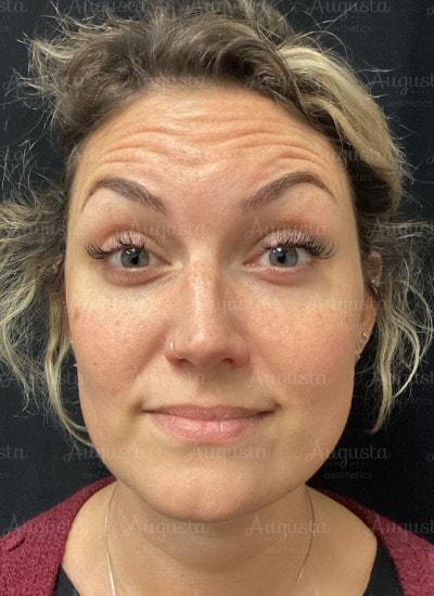 Botox before at Augusta Aesthetics in Cincinnati, OH
