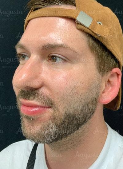 Lip Filler before at Augusta Aesthetics in Cincinnati, OH