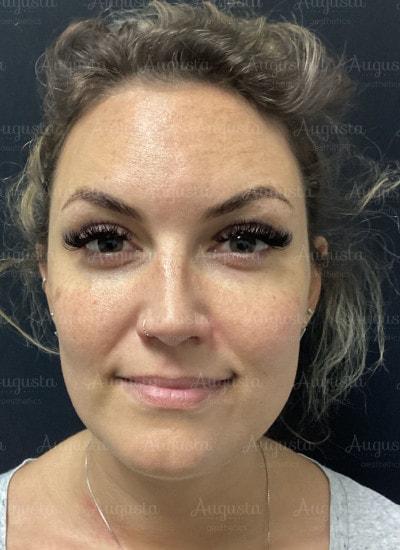 Augusta Aesthetics botox after — Cincinnati, OH