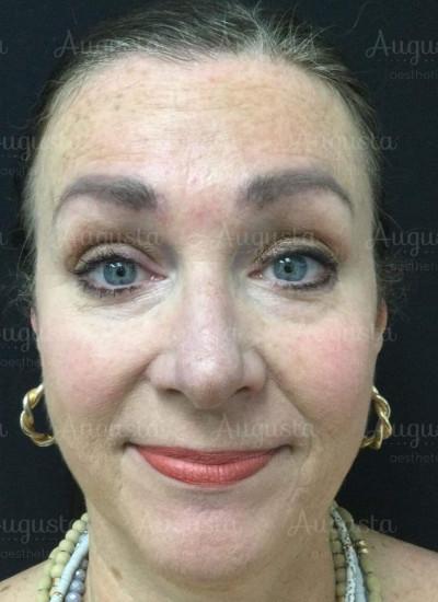Augusta Aesthetics after — Cincinnati, OH