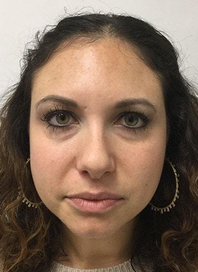 Lip Filler before at Augusta Aesthetics in Cincinnati, OH