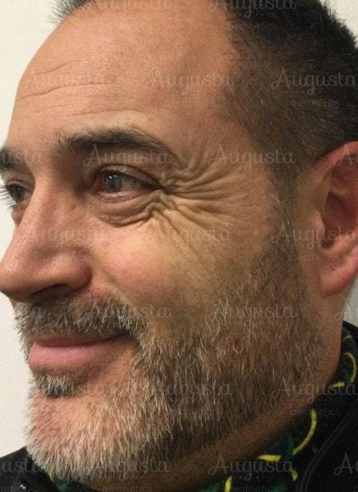 Botox before at Augusta Aesthetics in Cincinnati, OH
