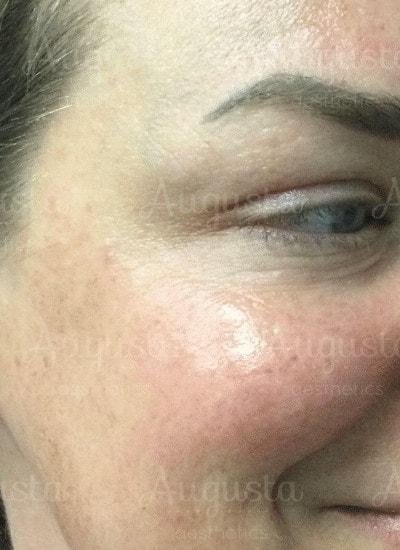 Botox after at Augusta Aesthetics in Cincinnati, OH
