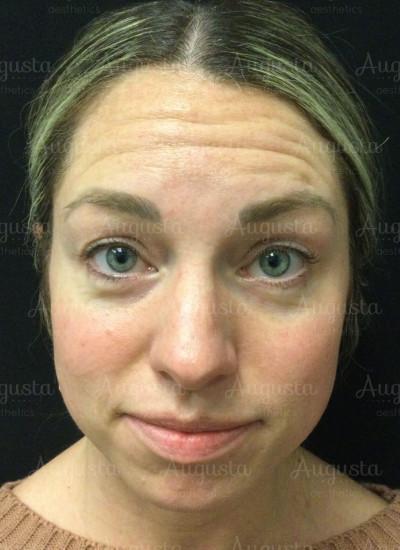 Botox before at Augusta Aesthetics in Cincinnati, OH