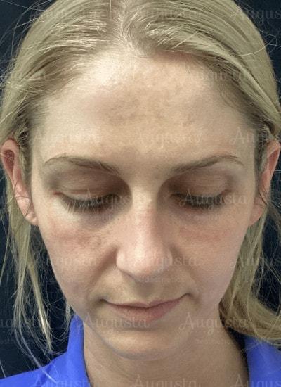Juvederm before at Augusta Aesthetics in Cincinnati, OH