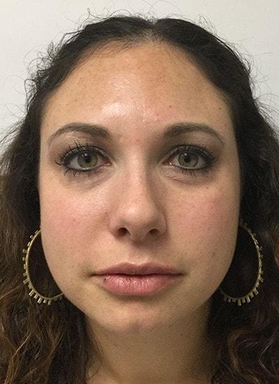 Augusta Aesthetics lip filler after — Cincinnati, OH