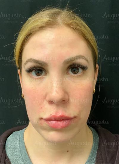 Lip Filler after at Augusta Aesthetics in Cincinnati, OH