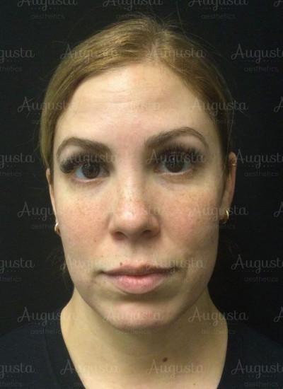 Lip Filler before at Augusta Aesthetics in Cincinnati, OH