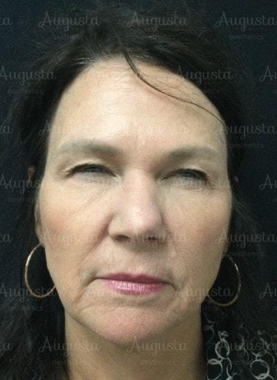 Augusta Aesthetics botox after — Cincinnati, OH