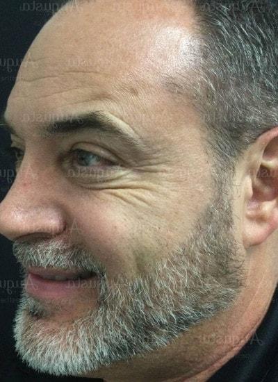 Botox after at Augusta Aesthetics in Cincinnati, OH