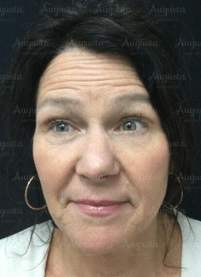 Botox before at Augusta Aesthetics in Cincinnati, OH
