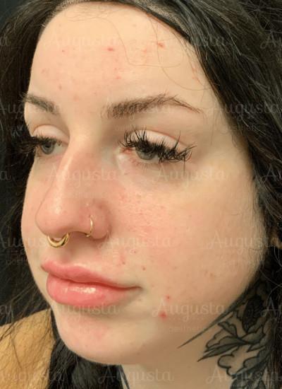 Augusta Aesthetics after — Cincinnati, OH
