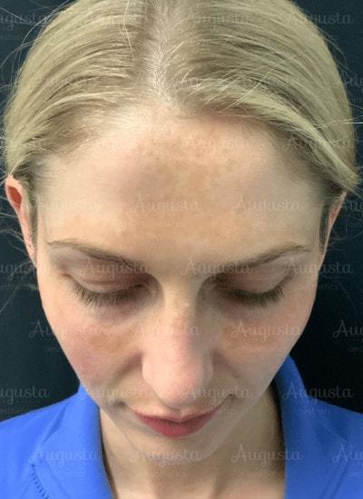 Juvederm after at Augusta Aesthetics in Cincinnati, OH
