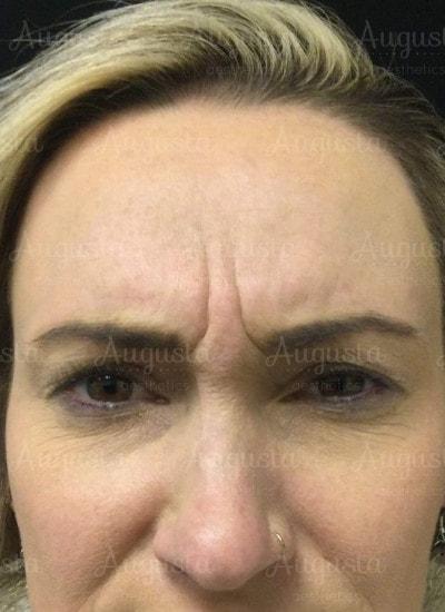 Botox before at Augusta Aesthetics in Cincinnati, OH