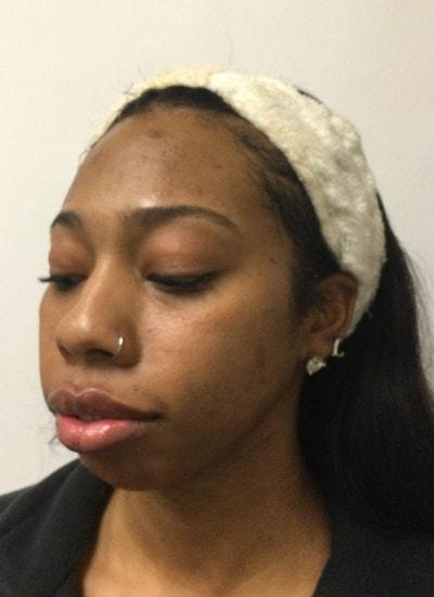 Augusta Aesthetics lip filler after — Cincinnati, OH