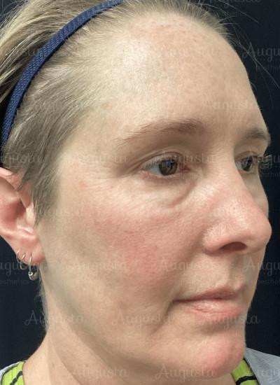 Augusta Aesthetics after — Cincinnati, OH