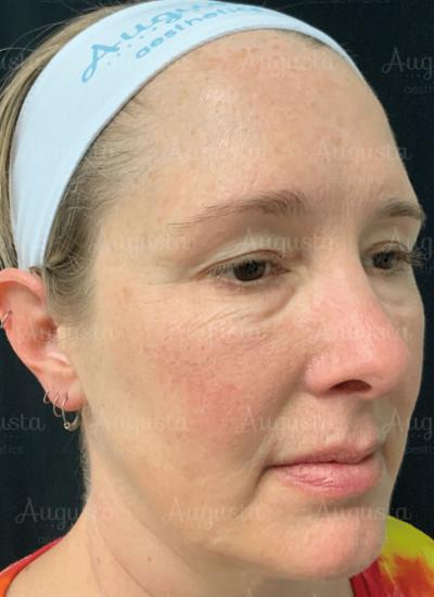 Juvederm before at Augusta Aesthetics in Cincinnati, OH
